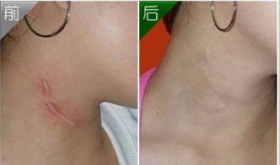 廣州隆胸手術(shù)費(fèi)用及案例分享，口碑如何？