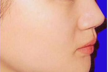 南京施爾美劉衛(wèi)豐鼻匠：獨具實力，成功案例揭秘！