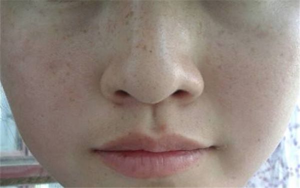 蘇州芘麗芙華美美容醫(yī)院耳軟骨整形效果和收費(fèi)詳解