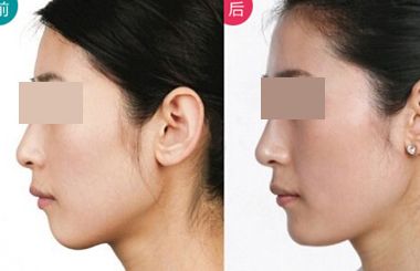 上海哪個醫(yī)生擅長鼻翼縮??？2023年度網(wǎng)民口碑推薦醫(yī)生名冊曝光