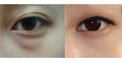 羅日云整容醫(yī)生的服務(wù)及費(fèi)用詳情，隱私公開(kāi)！優(yōu)質(zhì)雙眼皮案例與收費(fèi)一覽供參考！