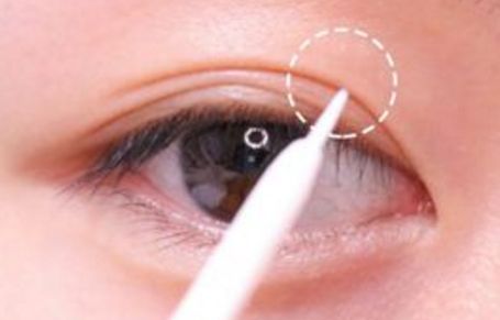 北京美聯(lián)臣路世敏醫(yī)生幫你告別歲月痕跡！除皺案例分享！