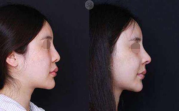 重慶美萊整形四月特惠，是不是只需6000元即可減400元？雙眼皮可以實現(xiàn)嗎？