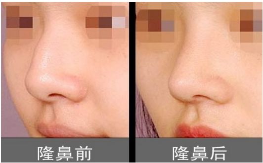 上海柴云醫(yī)生雙眼整形效果完美！手術(shù)前后真實照片呈現(xiàn)出專業(yè)水平