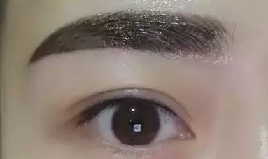 浙二醫(yī)院葉娟為患者打造完美雙眼皮，成就精致美眸