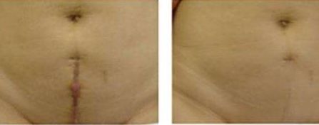 重慶張恒術進行雙眼皮手術，醫(yī)生實力以及成功案例展示