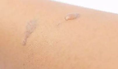 整形醫(yī)生楊小順在鄭州陽光創(chuàng)美進(jìn)行眼部手術(shù)口碑如何？