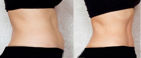 英諾小棕瓶的微針和滾針，如何選擇？英諾小棕瓶反黑效果需要多久呢？