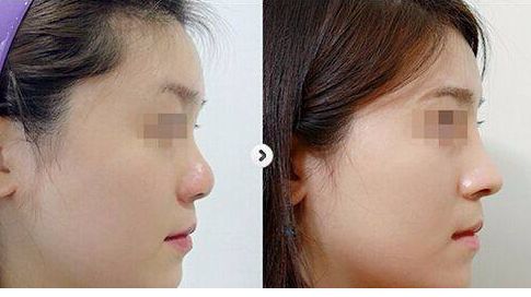 揭秘廣州整容界很受推崇的隆鼻醫(yī)生排行榜！TOP10豪華陣容對決，尊貴專家非一般醫(yī)師！