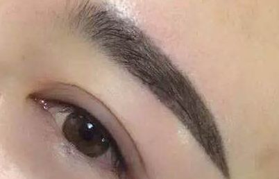 2023長沙愛思特張嬌嬌雙眼皮效果曝光！案例解析引發(fā)熱議