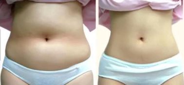 成都最佳面部吸脂醫(yī)生排名揭曉！八大靠譜醫(yī)生名單引爆話題！