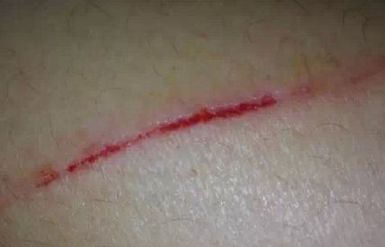 如何通過(guò)李小正醫(yī)生的雙眼皮手術(shù)來(lái)提升西安人的顏值