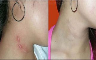 北京首都整形醫(yī)院雙眼皮修復(fù)效果如何？詳細(xì)案例揭秘