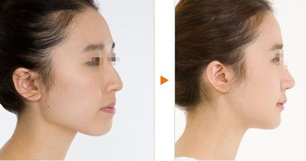 沈陽隆胸整形哪家醫(yī)院技術領先？頭部醫(yī)療機構推崇，專業(yè)醫(yī)生幫您圓夢