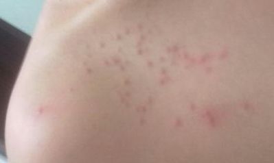 北京萬達(dá)行姜洪濤醫(yī)生最新開眼角效果分享！2023年價(jià)格公布！