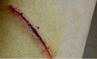 長沙治療內眼角問題哪家醫(yī)院靠譜？這些醫(yī)療機構備受推崇