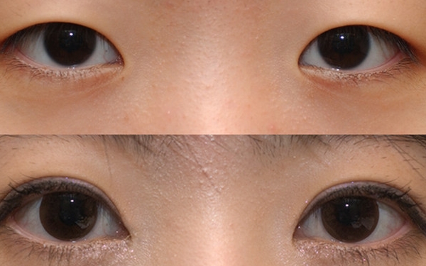 上海哪家醫(yī)院做眼袋手術(shù)價格實惠又靠譜？排行榜前十強！