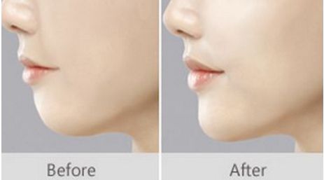 上海唇裂修復(fù)的五家知名醫(yī)院，人氣爆棚，不容錯過！