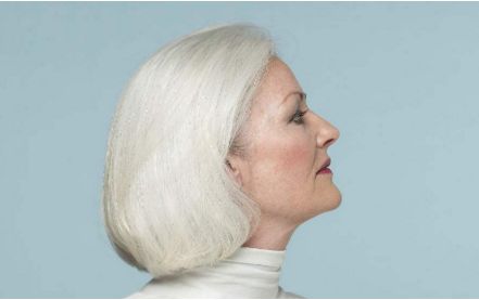 湖州98醫(yī)院面部脂肪填充案例分享，顛覆傳統(tǒng)整形方法