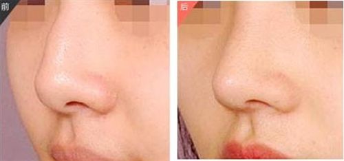 田孝臣醫(yī)生的鼻部整形效果如何？?jī)r(jià)格如何？技術(shù)評(píng)價(jià)+成功案例解析