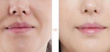 南京華韓奇致醫(yī)生解答：如何進行眼睛手術(shù)？2023真實案例發(fā)布