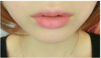 年齡段選擇，雙眼皮手術(shù)何時較適宜