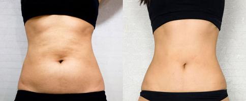 延安醫(yī)院隆胸效果如何？哪位專家值得信賴？