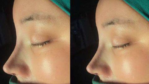 最佳2023西安雙眼皮修復醫(yī)生推薦！宋保強、馬顯杰好評如潮，立即預約！