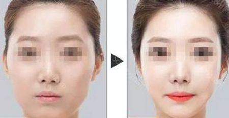 徐州整容機(jī)構(gòu)最佳隆鼻前六強(qiáng)盛名大揭曉！網(wǎng)友：此篇一看便心動(dòng)，可投入購置。