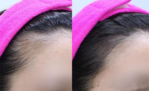 鄭州哪家醫(yī)院擅長祛斑，技術(shù)精湛值得推薦！