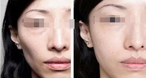 注射隆鼻，需要了解的材料有哪些？