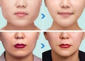 杭州哪家醫(yī)院做下頜角整形效果好？綜合口碑、價(jià)格受好評(píng)的幾家醫(yī)院推薦