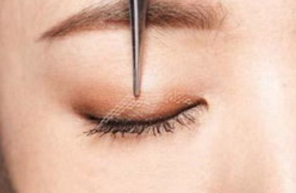 鄭州賈亮眼部整形技術(shù)介紹，修復(fù)雙眼皮效果如何？成功案例披露