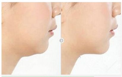 高偉的頜骨修復(fù)費(fèi)用及綜合實(shí)力揭秘，醫(yī)生專業(yè)解讀技術(shù)及真實(shí)案例分享