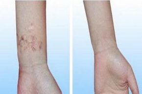 蘇州哪家醫(yī)院適合做雙眼皮修復(fù)手術(shù)？眼部整形修復(fù)有哪些選擇？