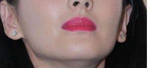 林沸騰曼陀假體現(xiàn)狀解析及2023價格一覽