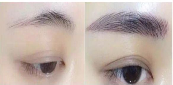 專家為您解答：涿州市哪家醫(yī)院可進(jìn)行瘦臉針治療？費用如何？醫(yī)師推薦為參考