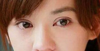 探索成都圣丹福整形醫(yī)院的雙眼皮修復(fù)成果，經(jīng)驗(yàn)分享