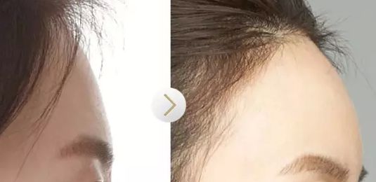 廣州顏玲診所最新出爐吸脂技術(shù)效果如何？該醫(yī)院案例曝光