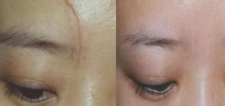 杭州一位醫(yī)生的雙眼皮手術(shù)實(shí)踐分享，持續(xù)80天的親身經(jīng)歷！