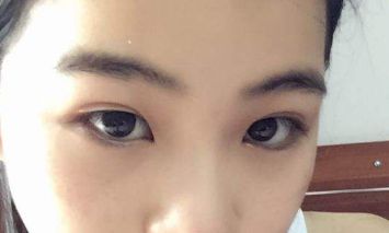 北京知音吸脂醫(yī)生分享大腿吸脂案例，想了解吸脂效果的朋友必看