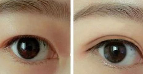 葉飛輪醫(yī)生：雙眼皮手術(shù)技術(shù)解析，真人案例揭秘！