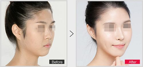 哪家杭州雙眼皮技術(shù)口碑好？排行榜對(duì)比評(píng)析！