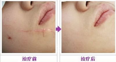 廣州做吸脂手術(shù)哪家醫(yī)院效果好？這幾家技術(shù)領(lǐng)先