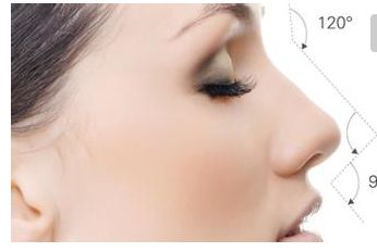 無錫二院隆鼻效果及費(fèi)用情況詳解，醫(yī)生分享成功案例