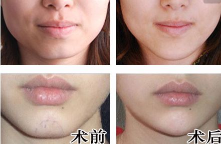 廣州人中縮短手術(shù)醫(yī)生推薦？網(wǎng)友真實評價與信息公開！