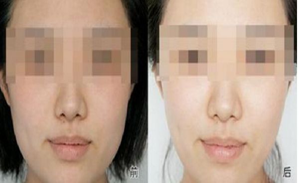 浙江省中醫(yī)院雙眼皮手術優(yōu)質醫(yī)生及案例評價