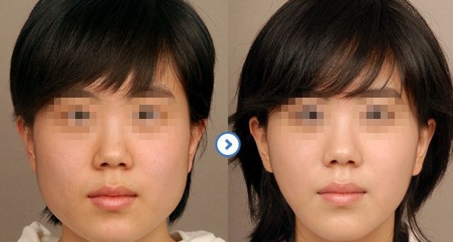 成都隆鼻醫(yī)生排行榜2024：專家推薦的醫(yī)院大揭秘！