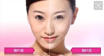 廣州哪家醫(yī)院可以安全進(jìn)行拉皮手術(shù)？