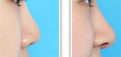 河南人氣玻尿酸填鼻唇溝醫(yī)院口碑榜新鮮出爐，費(fèi)用一覽表請收好